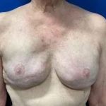 Implant Exchange Due to Ruptured Silicone Before & After Patient #2081