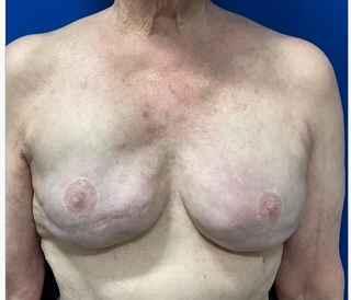 Implant Exchange Due to Ruptured Silicone Before & After Patient #2081