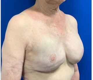 Implant Exchange Due to Ruptured Silicone Before & After Patient #2081