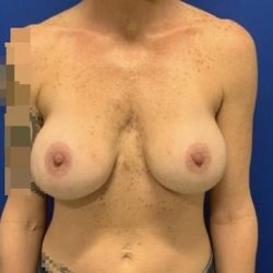 Implant Exchange Due to Ruptured Silicone Before & After Patient #2079