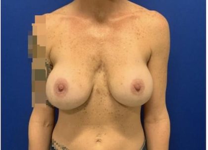 Implant Exchange Due to Ruptured Silicone Before & After Patient #2079