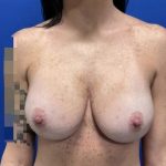 Implant Exchange Due to Ruptured Silicone Before & After Patient #2079