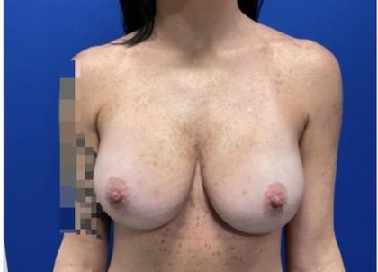 Implant Exchange Due to Ruptured Silicone Before & After Patient #2079