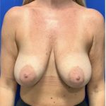 Implant Revision/Removal Before & After Patient #2078