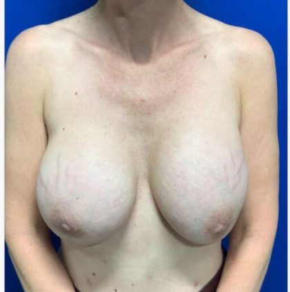 Implant Revision/Removal Before & After Patient #2077