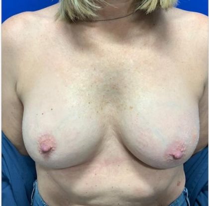 Implant Revision/Removal Before & After Patient #2076