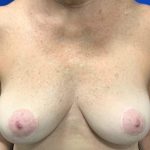 Implant Revision/Removal Before & After Patient #2075