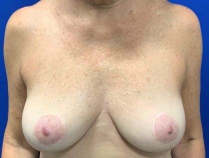 Implant Revision/Removal Before & After Patient #2075