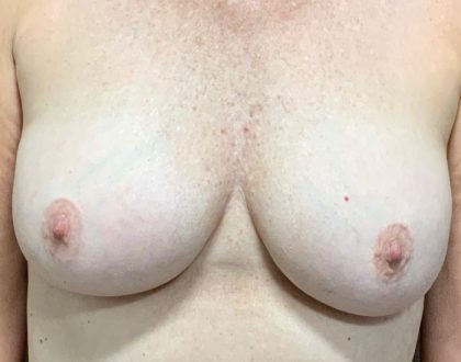 Implant Revision/Removal Before & After Patient #2074