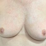 Implant Revision/Removal Before & After Patient #2074