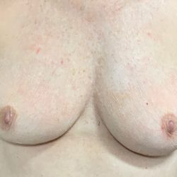 Implant Revision/Removal Before & After Patient #2074