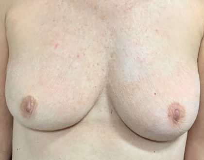 Implant Revision/Removal Before & After Patient #2074