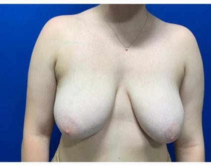 Breast Reduction With Galaflex Before & After Patient #2064