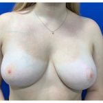 Breast Reduction With Galaflex Before & After Patient #2064