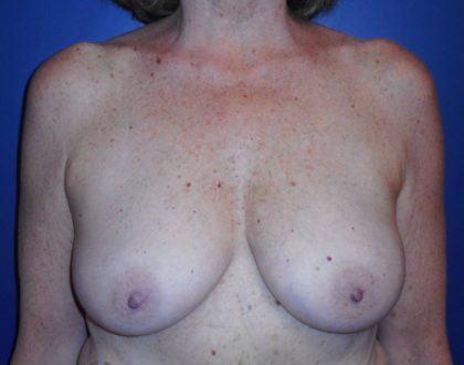 Breast Reduction With Galaflex Before & After Patient #2063