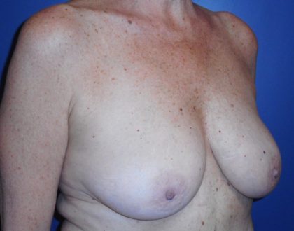 Breast Reduction With Galaflex Before & After Patient #2063