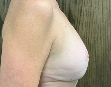 Breast Reduction With Galaflex Before & After Patient #2063
