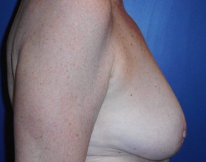 Breast Reduction With Galaflex Before & After Patient #2063