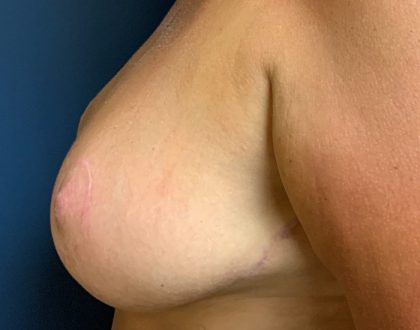 Breast Reduction With Galaflex Before & After Patient #2062