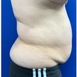 Emsculpt Neo Before & After Patient #2070