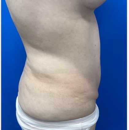 Emsculpt Neo Before & After Patient #2070