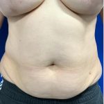 Emsculpt Neo Before & After Patient #2070