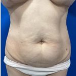 Emsculpt Neo Before & After Patient #2070