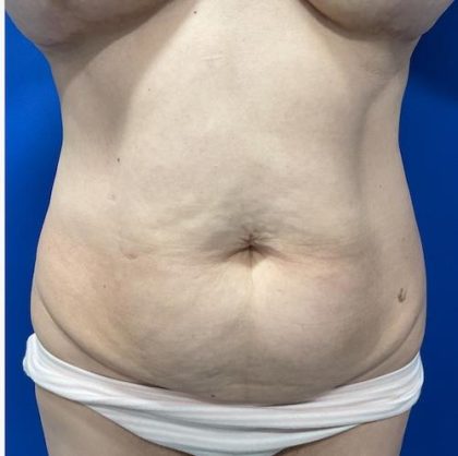 Emsculpt Neo Before & After Patient #2070