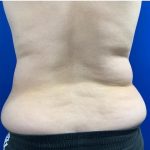 Emsculpt Neo Before & After Patient #2070