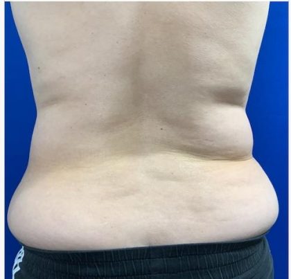 Emsculpt Neo Before & After Patient #2070