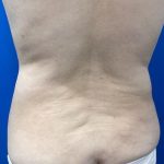 Emsculpt Neo Before & After Patient #2070