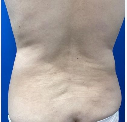 Emsculpt Neo Before & After Patient #2070