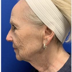 Facial Resurfacing Before & After Patient #2073