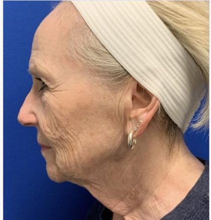 Facial Resurfacing Before & After Patient #2073