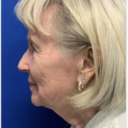 Facial Resurfacing Before & After Patient #2073
