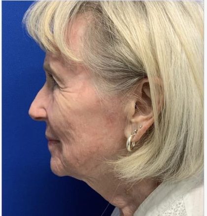 Facial Resurfacing Before & After Patient #2073