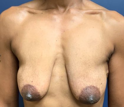 Breast Lift Before & After Patient #2058