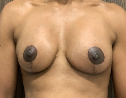 Breast Lift Before & After Patient #2058