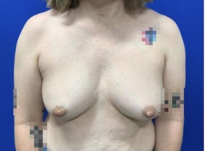 Breast Reconstruction with Direct to Implant with Silicone Implants Before & After Patient #2039
