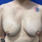 Breast Reconstruction with Direct to Implant with Silicone Implants Before & After Patient #2039