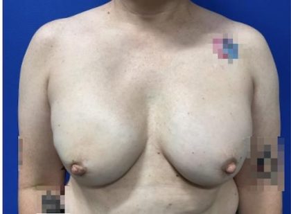 Breast Reconstruction with Direct to Implant with Silicone Implants Before & After Patient #2039