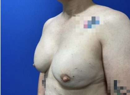 Breast Reconstruction with Direct to Implant with Silicone Implants Before & After Patient #2039