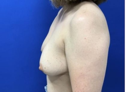 Breast Reconstruction with Direct to Implant with Silicone Implants Before & After Patient #2039