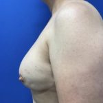 Breast Reconstruction with Direct to Implant with Silicone Implants Before & After Patient #2039
