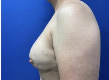 Breast Reconstruction with Direct to Implant with Silicone Implants Before & After Patient #2039
