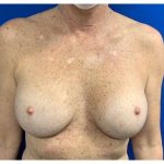Breast Reconstruction with Direct to Implant with Silicone Implants Before & After Patient #2050