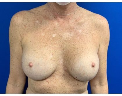 Breast Reconstruction with Direct to Implant with Silicone Implants Before & After Patient #2050