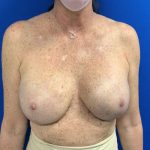 Breast Reconstruction with Direct to Implant with Silicone Implants Before & After Patient #2050