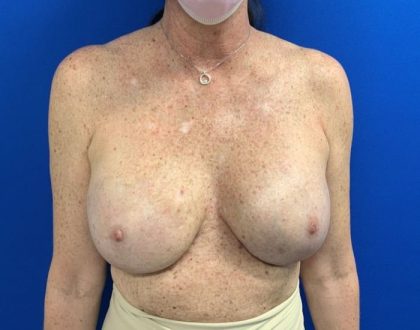 Breast Reconstruction with Direct to Implant with Silicone Implants Before & After Patient #2050