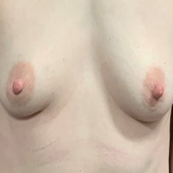 Breast Reconstruction with Direct to Implant with Silicone Implants Before & After Patient #2046